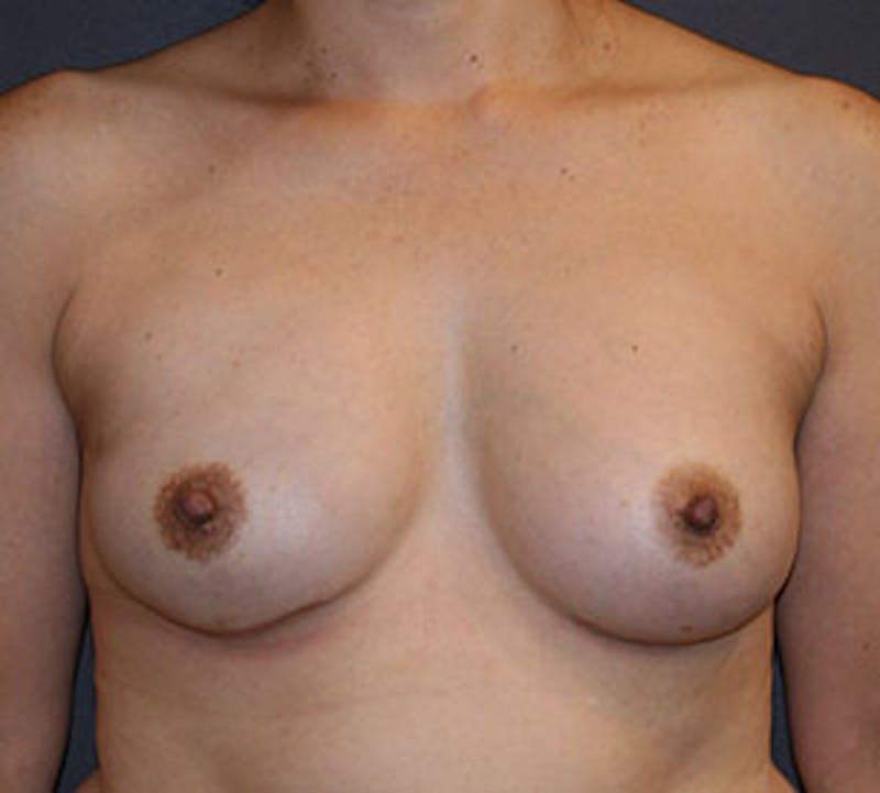 Breast Reconstruction Gallery - Patient 107001375 - Image 2