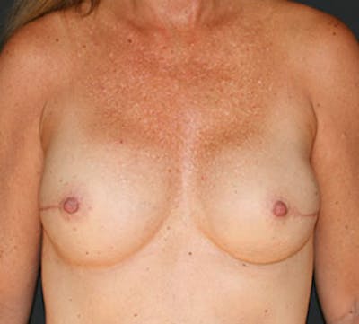 Breast Reconstruction Before & After Gallery - Patient 107001394 - Image 2