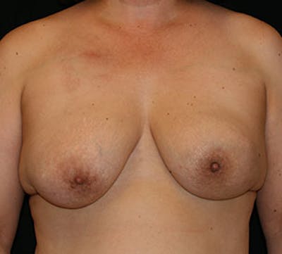 Breast Reconstruction Before & After Gallery - Patient 107001400 - Image 1