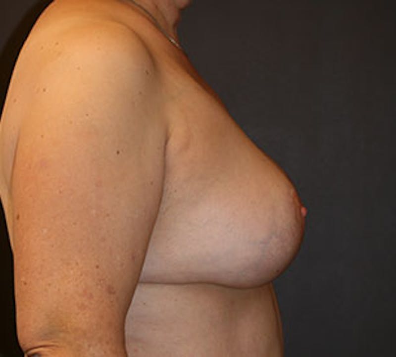 Breast Reconstruction Before & After Gallery - Patient 107001400 - Image 8