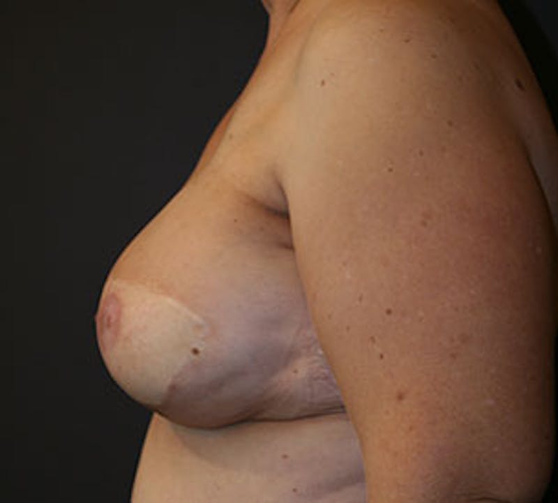 Breast Reconstruction Before & After Gallery - Patient 107001400 - Image 10