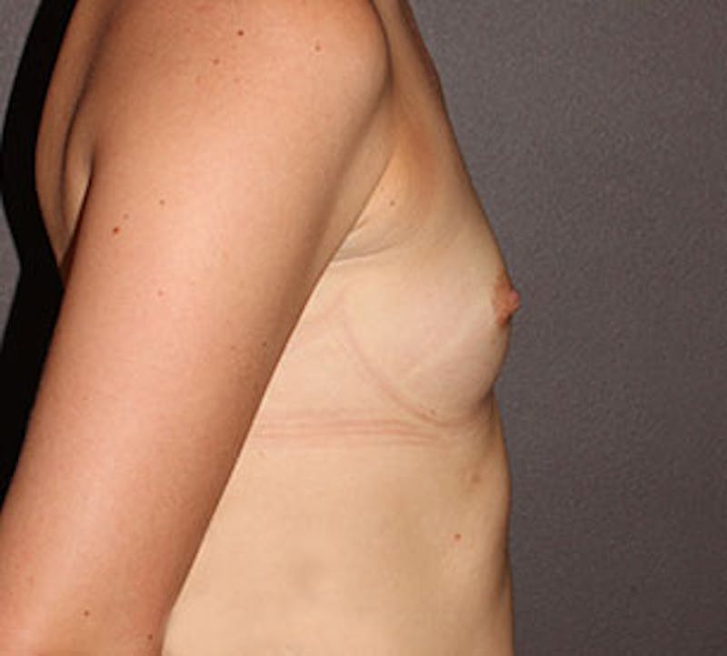 Breast Augmentation Before & After Gallery - Patient 149119724 - Image 7