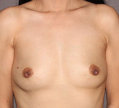 Breast Augmentation Before & After Gallery - Patient 149119730 - Image 1