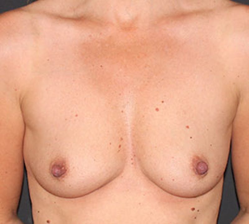 Breast Augmentation Before & After Gallery - Patient 149119731 - Image 1