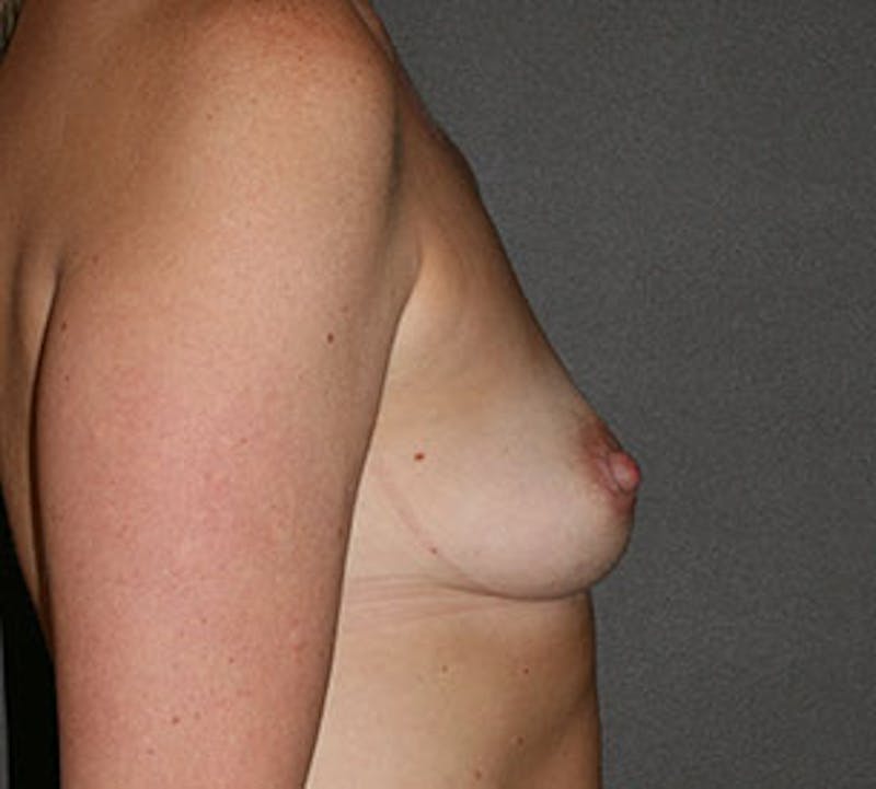 Breast Augmentation Before & After Gallery - Patient 149119743 - Image 7