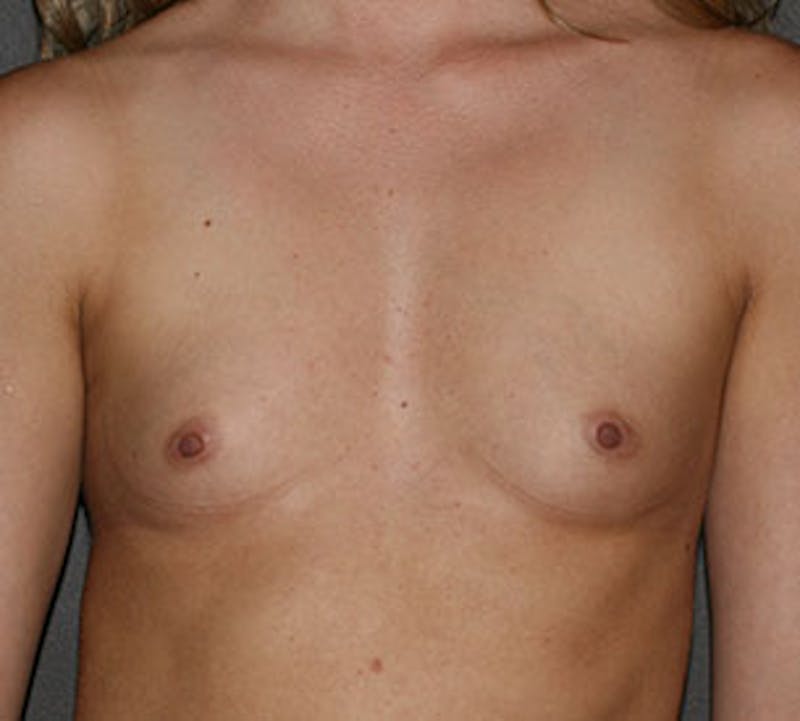 Breast Augmentation Before & After Gallery - Patient 149119746 - Image 1