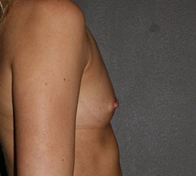 Breast Augmentation Before & After Gallery - Patient 149119746 - Image 9