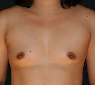 Breast Augmentation Before & After Gallery - Patient 149119747 - Image 1
