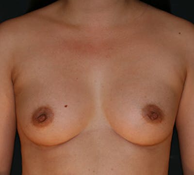 Breast Augmentation Before & After Gallery - Patient 149119747 - Image 2