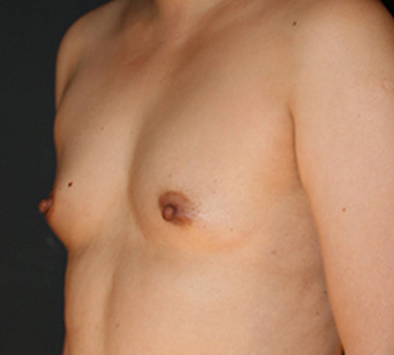 Breast Augmentation Before & After Gallery - Patient 149119747 - Image 5