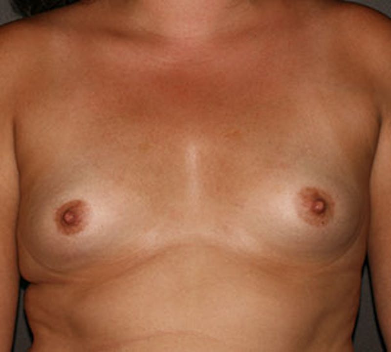 Breast Augmentation Before & After Gallery - Patient 149119755 - Image 1