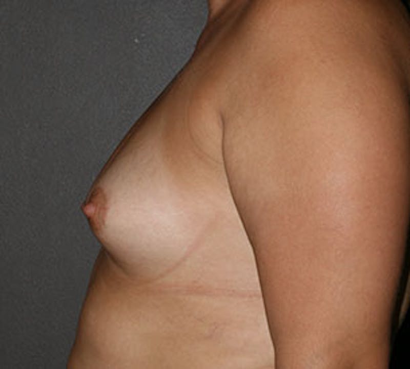 Breast Augmentation Before & After Gallery - Patient 149119755 - Image 9