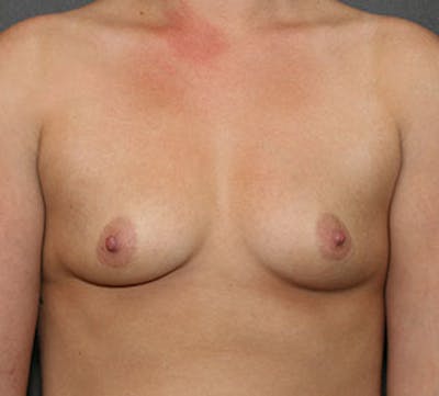 Breast Augmentation Before & After Gallery - Patient 149119760 - Image 1