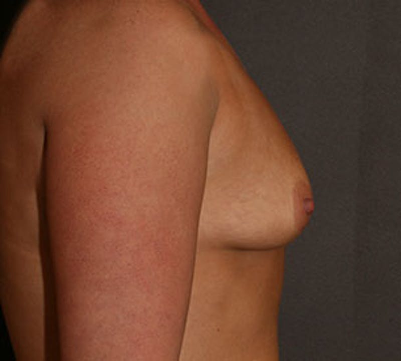 Breast Augmentation Before & After Gallery - Patient 149119760 - Image 7