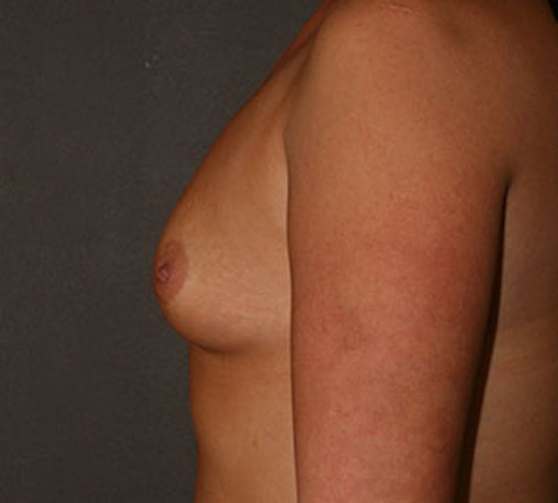 Breast Augmentation Before & After Gallery - Patient 149119760 - Image 9