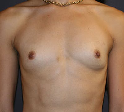 Breast Augmentation Before & After Gallery - Patient 149119765 - Image 1