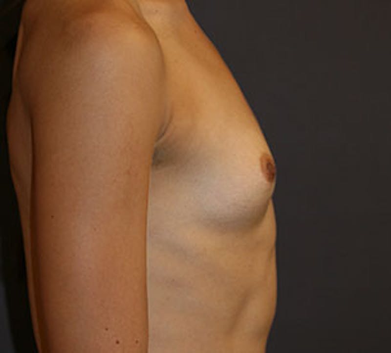 Breast Augmentation Before & After Gallery - Patient 149119765 - Image 7