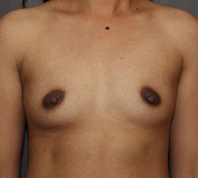 Breast Augmentation Before & After Gallery - Patient 149119769 - Image 1