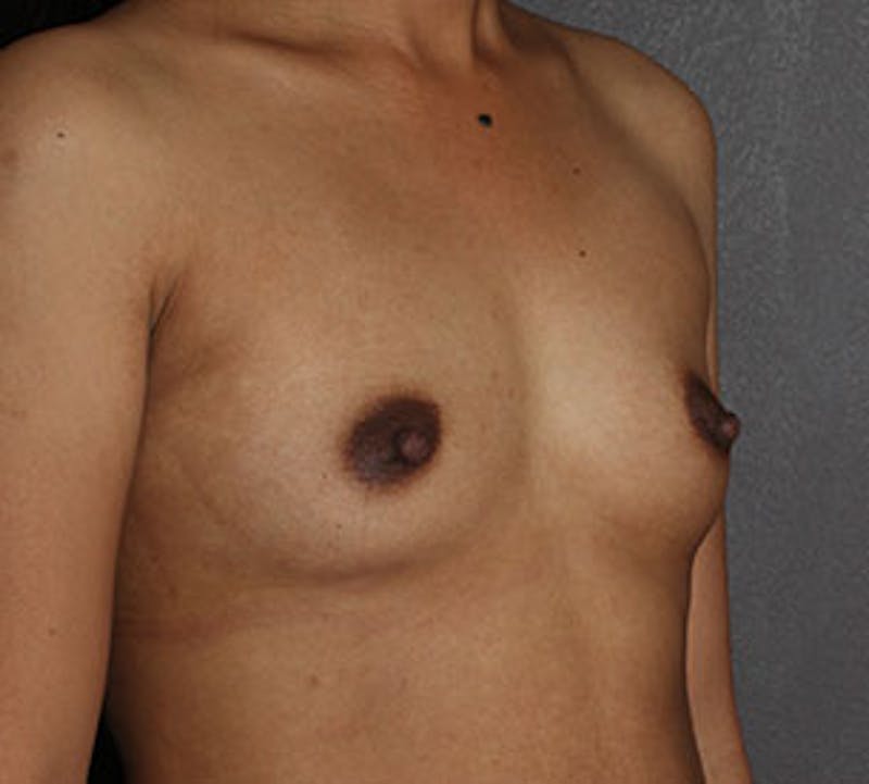 Breast Augmentation Before & After Gallery - Patient 149119769 - Image 3
