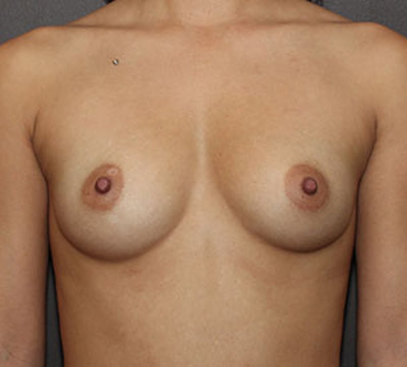 Breast Augmentation Before & After Gallery - Patient 149119772 - Image 1