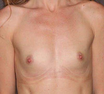 Breast Augmentation Before & After Gallery - Patient 149119776 - Image 1
