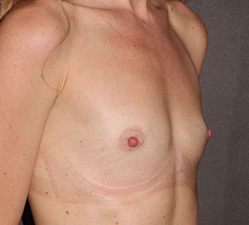 Breast Augmentation Before & After Gallery - Patient 149119776 - Image 3