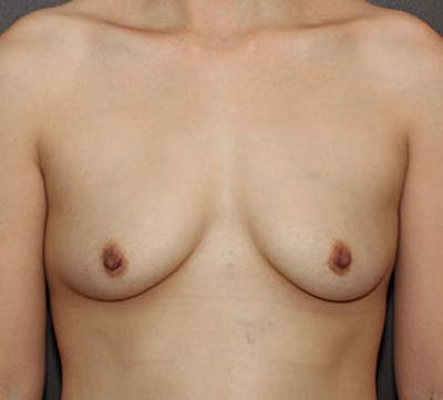 Breast Augmentation Before & After Gallery - Patient 149119781 - Image 1