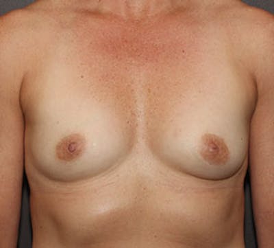 Breast Augmentation Before & After Gallery - Patient 149119782 - Image 1