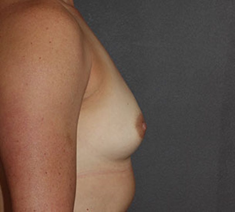 Breast Augmentation Before & After Gallery - Patient 149119782 - Image 7