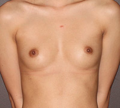 Breast Augmentation Before & After Gallery - Patient 149119803 - Image 1