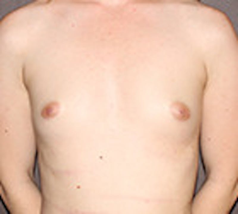 Breast Augmentation Before & After Gallery - Patient 149119805 - Image 1