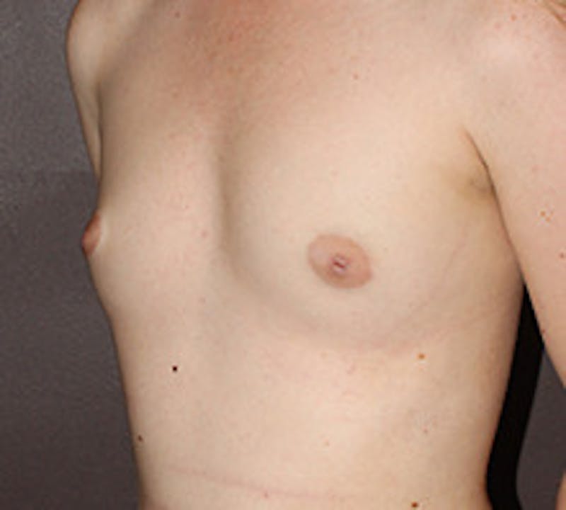 Breast Augmentation Before & After Gallery - Patient 149119805 - Image 5
