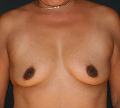 Breast Augmentation Before & After Gallery - Patient 149119806 - Image 1