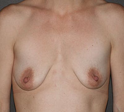 Breast Augmentation Before & After Gallery - Patient 149119812 - Image 1