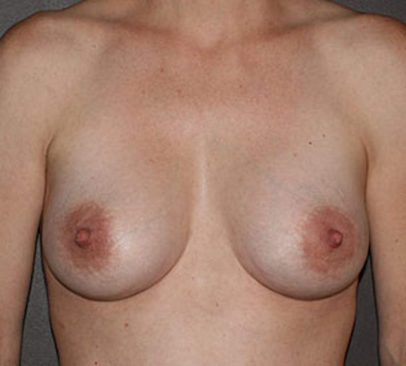 Breast Augmentation Before & After Gallery - Patient 149119812 - Image 2