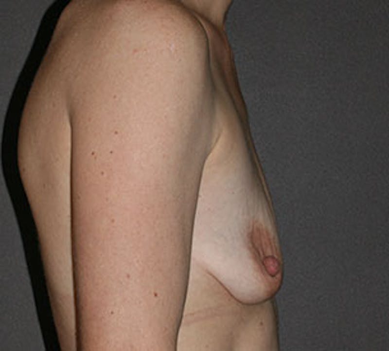 Breast Augmentation Before & After Gallery - Patient 149119812 - Image 7