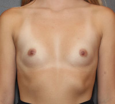 Breast Augmentation Before & After Gallery - Patient 365644 - Image 1