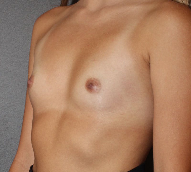 Breast Augmentation Before & After Gallery - Patient 365644 - Image 9