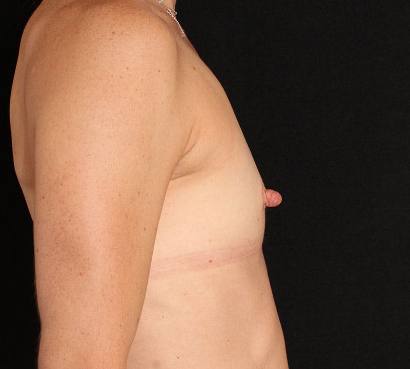 Breast Augmentation Before & After Gallery - Patient 315933 - Image 5