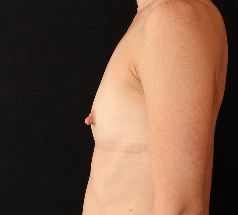 Breast Augmentation Before & After Gallery - Patient 315933 - Image 7