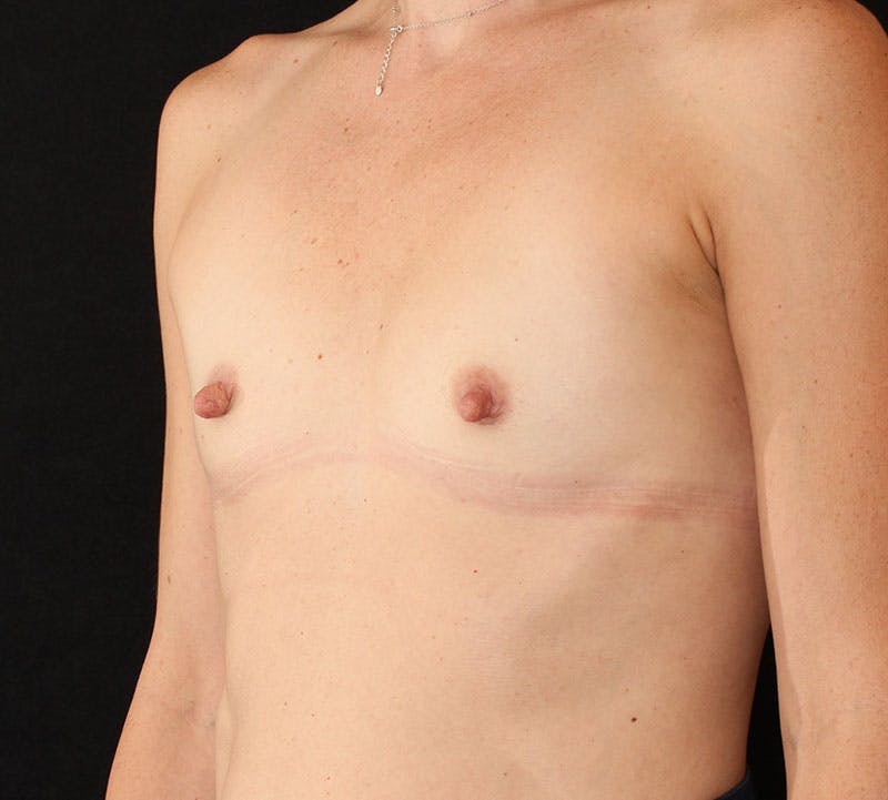 Breast Augmentation Before & After Gallery - Patient 315933 - Image 9