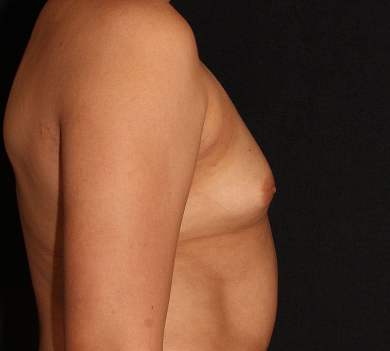 Breast Augmentation Before & After Gallery - Patient 412961 - Image 5