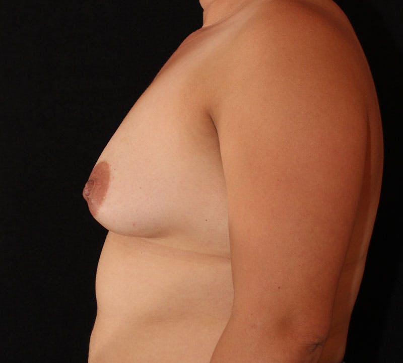 Breast Augmentation Before & After Gallery - Patient 151525 - Image 7
