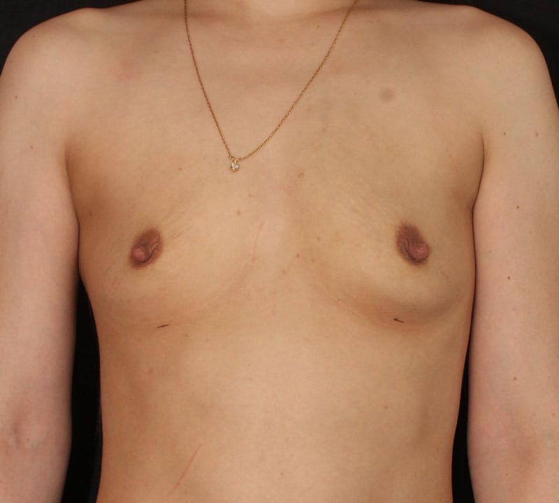 Breast Augmentation Before & After Gallery - Patient 313455 - Image 1