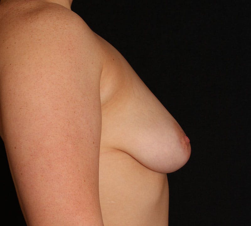 Augmentation-Mastopexy (Implant with Lift) Before & After Gallery - Patient 361120 - Image 5