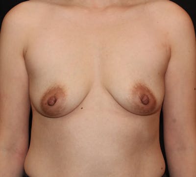 Augmentation-Mastopexy (Implant with Lift) Before & After Gallery - Patient 126512 - Image 1