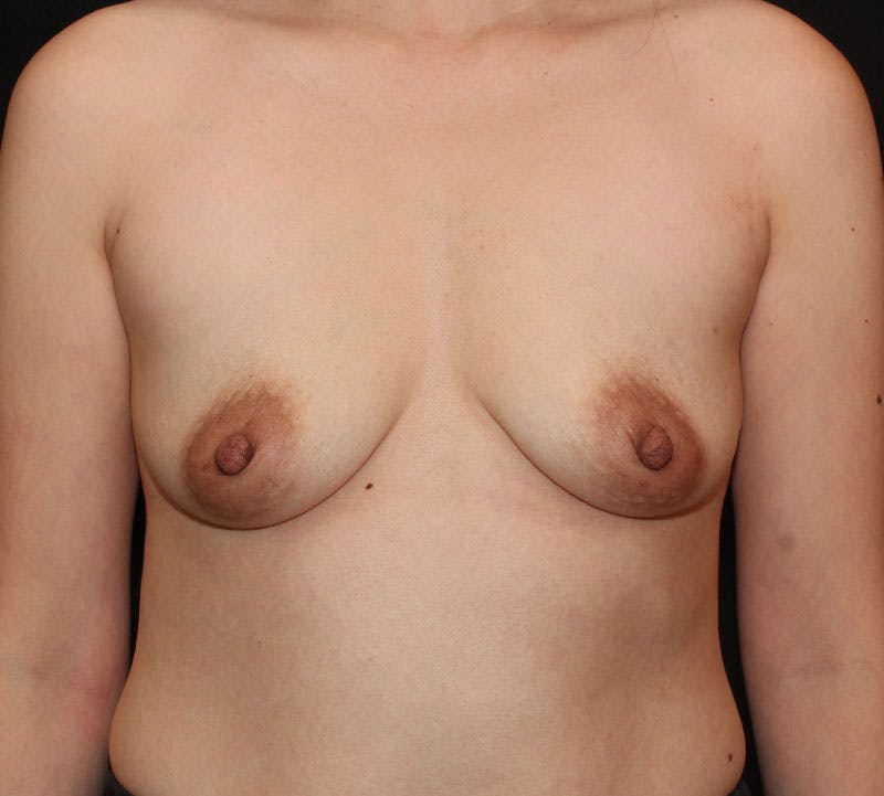 Augmentation-Mastopexy (Implant with Lift) Before & After Gallery - Patient 126512 - Image 1