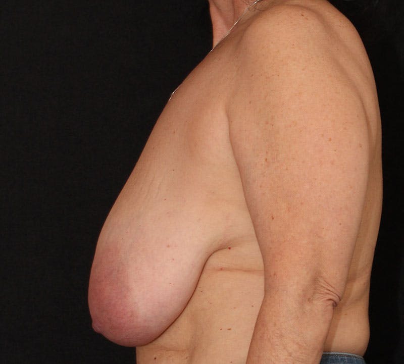 Breast Reduction and Mastopexy (Lift) Before & After Gallery - Patient 328502 - Image 7