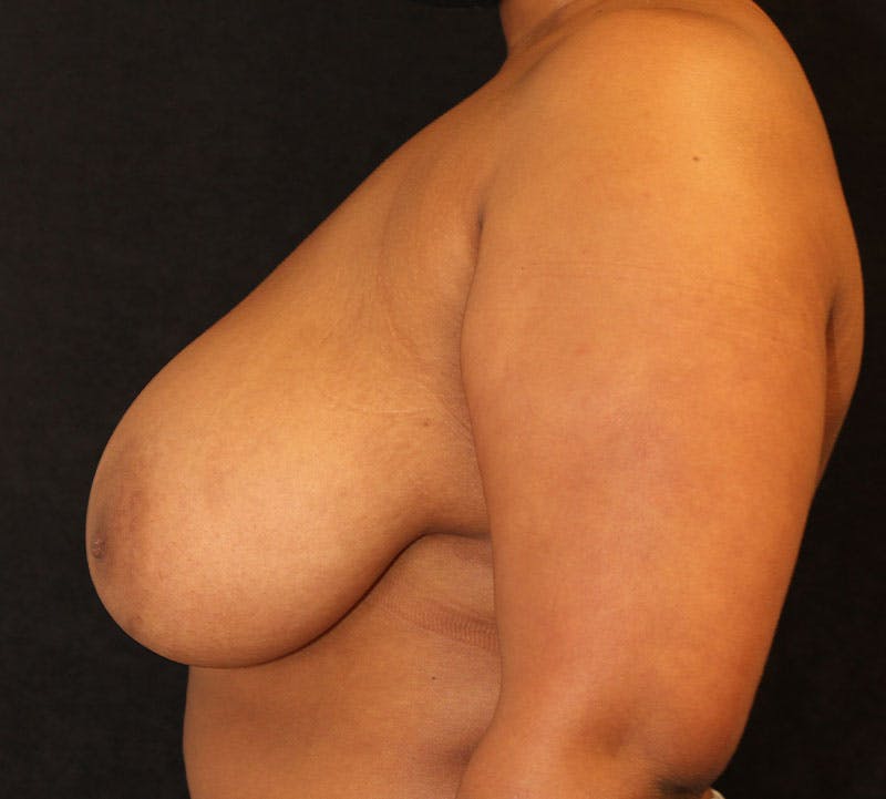 Breast Reduction and Mastopexy (Lift) Before & After Gallery - Patient 419646 - Image 7