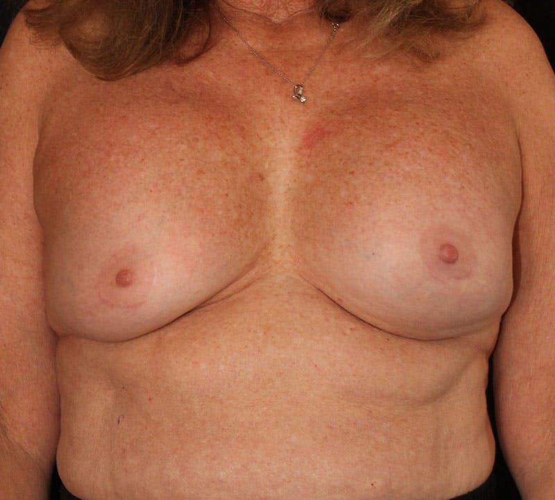 Breast Revision Before & After Gallery - Patient 100193 - Image 1